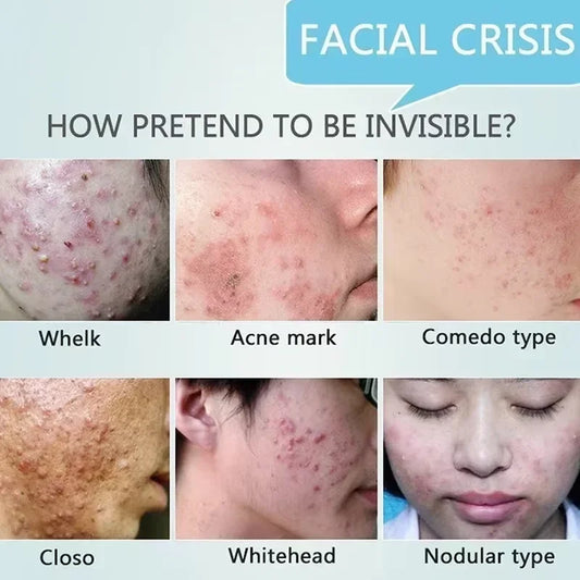 Pore Shrinking Cream Acne Pit Repair Products for Men and Women Remove acne mark scars Large pore anti-inflammatory smooth skin