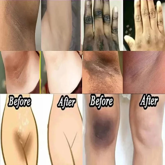 Nicotinamide Brightening Cream For Dark Skin Effective Lighten Thigh Inner Bleach Remove Melanin Private Parts Brighten Cream