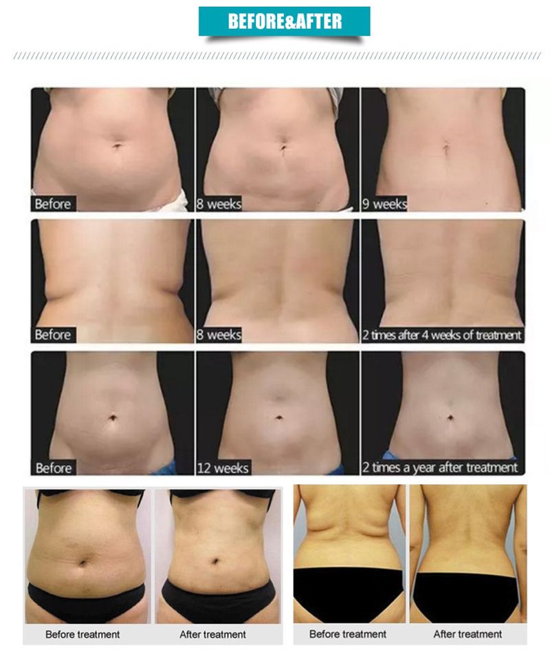 NEO Equipment Slimming Ultrasound Cellulite Wrinkle Removal Face Lift 2 Handles Ultra 360 Fat Reducing Machine For Salon