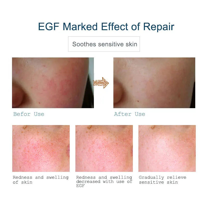 ARTISCARE EGF Face Serum for Skin Care Moisturizing Rejuvenation Cream Facial Oil Control Shrink Pores Essence
