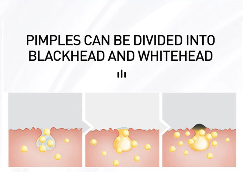 AUQUEST Acne Face Cream Salicylic Acid Oil Control Whitening Shrink Pores Beauty Health Korean Cosmetics Skin Care