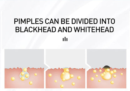 AUQUEST Acne Face Cream Salicylic Acid Oil Control Whitening Shrink Pores Beauty Health Korean Cosmetics Skin Care