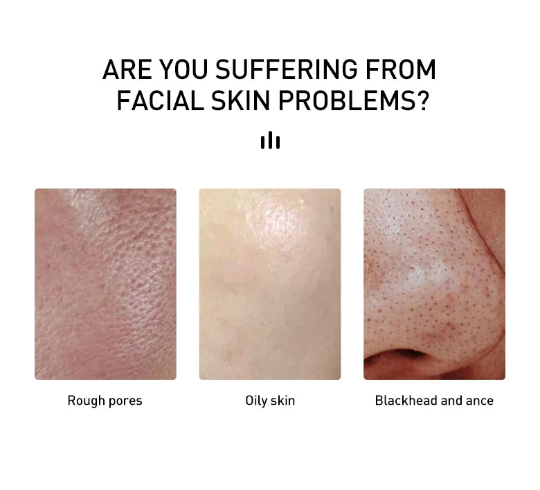 AUQUEST Acne Face Cream Salicylic Acid Oil Control Whitening Shrink Pores Beauty Health Korean Cosmetics Skin Care