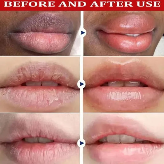Exfoliating Lip Treatment Mask Gloss - Lightening Melanin Dark Lip Balm Remove Pink Moisturizing Reduce Lip Lines Improve Drynes