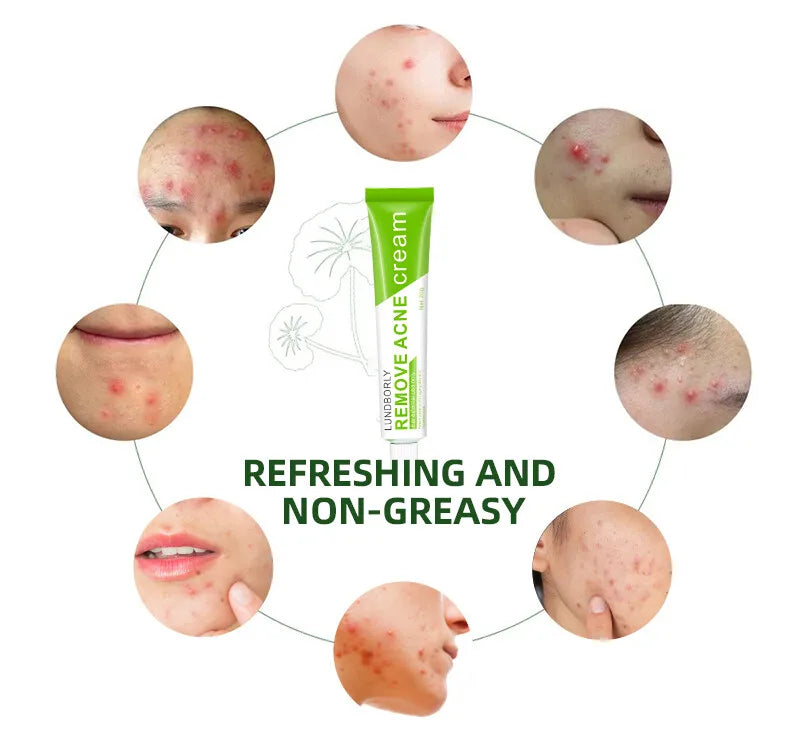 Natural Herbal Face Cream 20g Acne Cream with Salicylic Acid Oil Control Moisturizing Fading Acne Marks Gentle Non Irritating