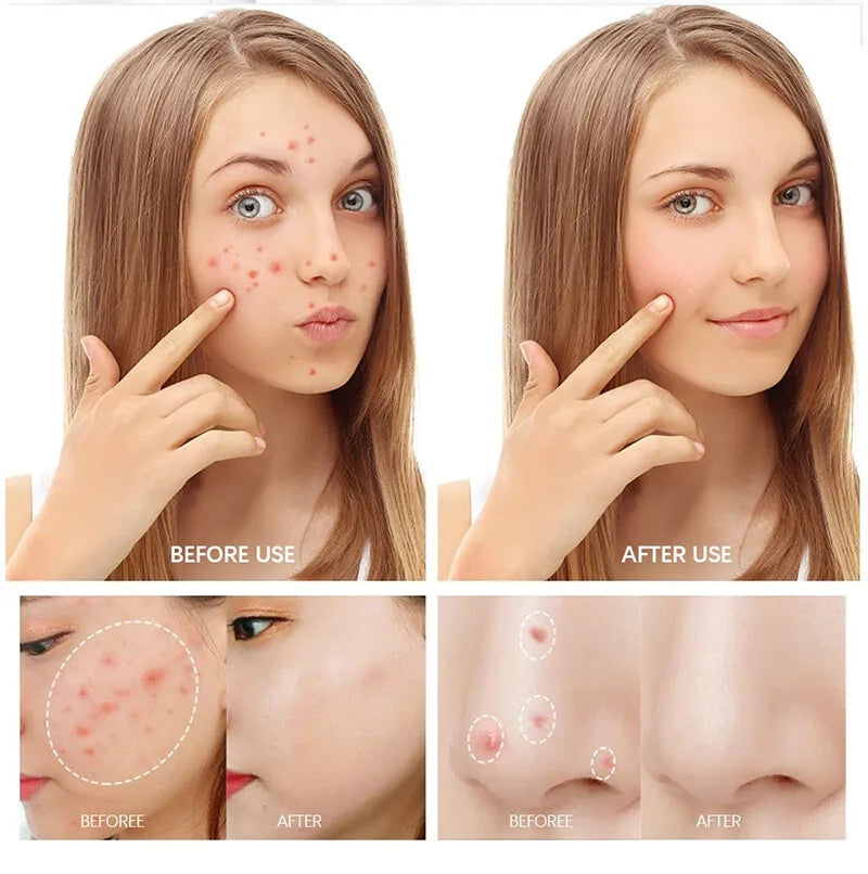 Natural Herbal Face Cream 20g Acne Cream with Salicylic Acid Oil Control Moisturizing Fading Acne Marks Gentle Non Irritating