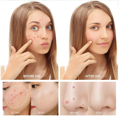 Natural Herbal Face Cream 20g Acne Cream with Salicylic Acid Oil Control Moisturizing Fading Acne Marks Gentle Non Irritating