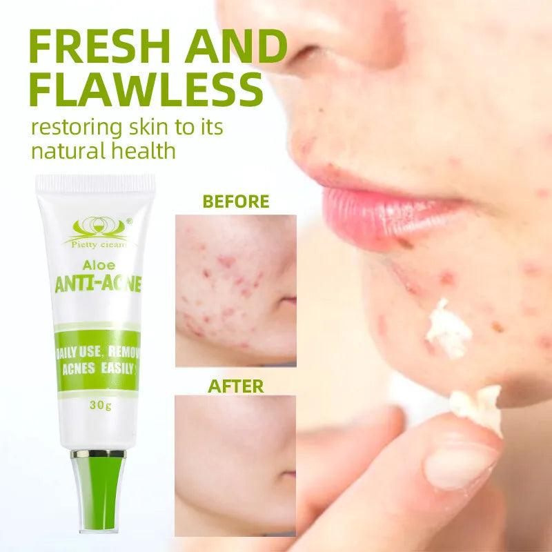 30g Acne Cream soothes, hydrates, helps regulate oil, reduces redness, and enhances skin texture with a moisturizing feel