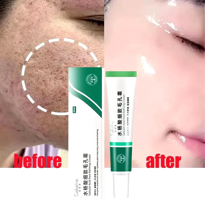 Salicylic Acid Pore Shrinking Cream Eliminate Large Pores Serum Remove Blackhead Acne Repairing Tightening Skin Care Cosmetics