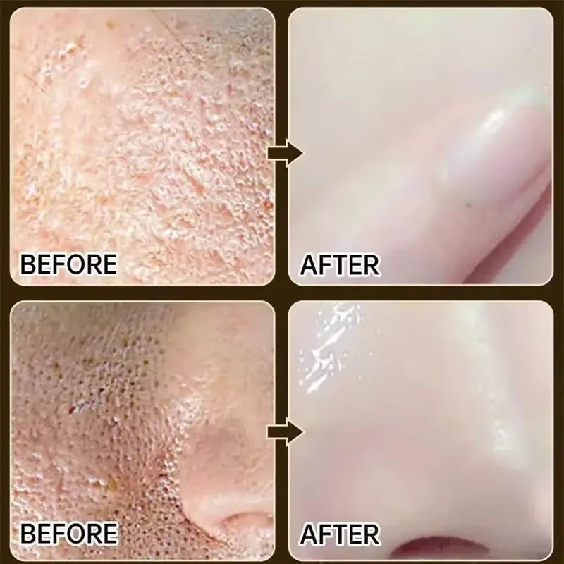 Salicylic Acid Pore Shrinking Cream Eliminate Large Pores Serum Remove Blackhead Acne Repairing Tightening Skin Care Cosmetics