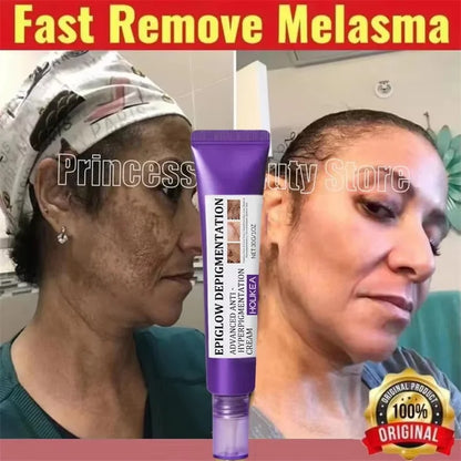 Whitening Freckle Cream Melasma Dark Spots Pigmentation Removal Product Fade Stain Melanin Fast Repair Brighten Korean Skin Care