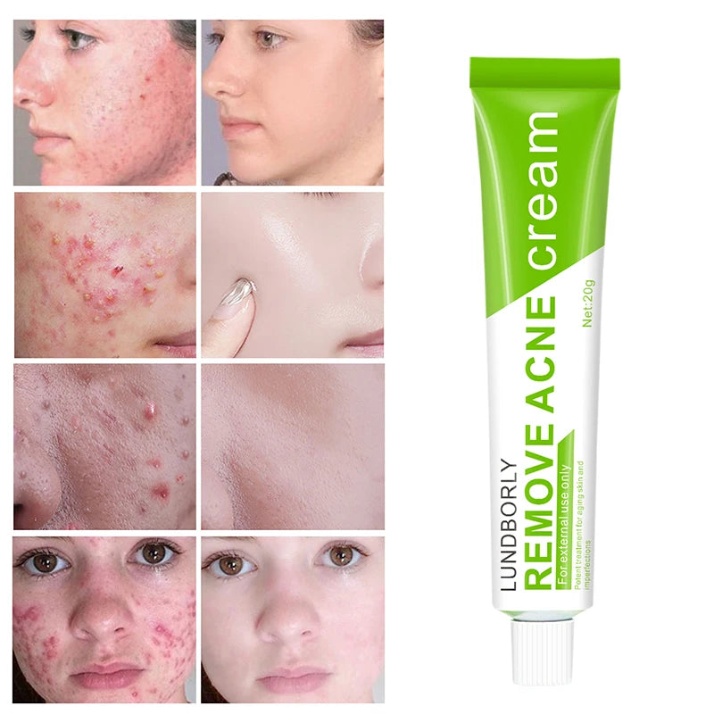 LUNDBORLY Acne Care Cream with Natural Herbal Extracts Helps Soothe Skin Improve Skin Texture and Keep Skin Smooth and Radiant
