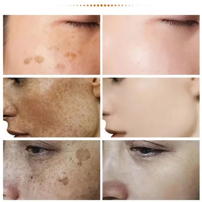 Nicotinamide Whitening Freckles Face Cream Remove Melasma Dark Spots Corrector Fade Melanin Acne Anti-Aging Brighten Skin Care
