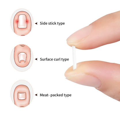 50Pcs Ingrown Toenail Correction Tool Ingrown Toe Nail Treatment Elastic Patch Sticker Straightening Clip Brace Pedicure Tool