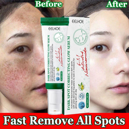 Nicotinamide Whitening Freckles Face Cream Remove Melasma Dark Spots Corrector Fade Melanin Acne Anti-Aging Brighten Skin Care