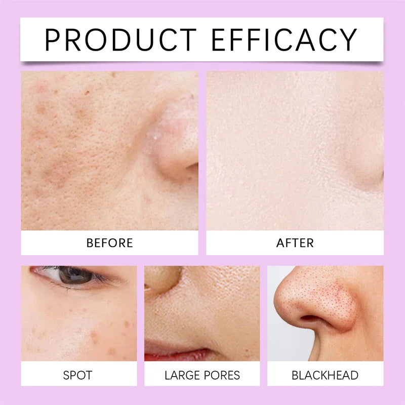 Dark Spots Remover Whitening Serum Face Freckle Melanin Correcting Anti Pigmentation Brighten Beauty Korean Day Night Skin Care