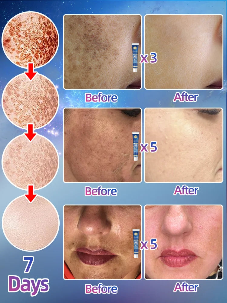 Freckles Cream Dark Spot
