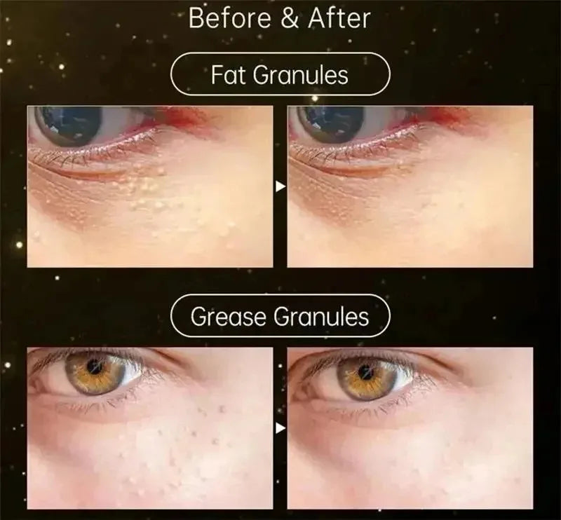 Fat Granules Remover Eye Cream Effective Remove Fat Granules Puffiness Anti-Particles Milia Remover Product Repair Eye Skin Care