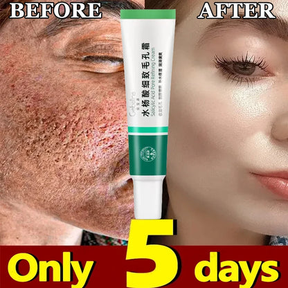 Salicylic Acid Pore Shrinking Cream Eliminate Large Pores Serum Remove Blackhead Acne Repairing Tightening Skin Care Cosmetics