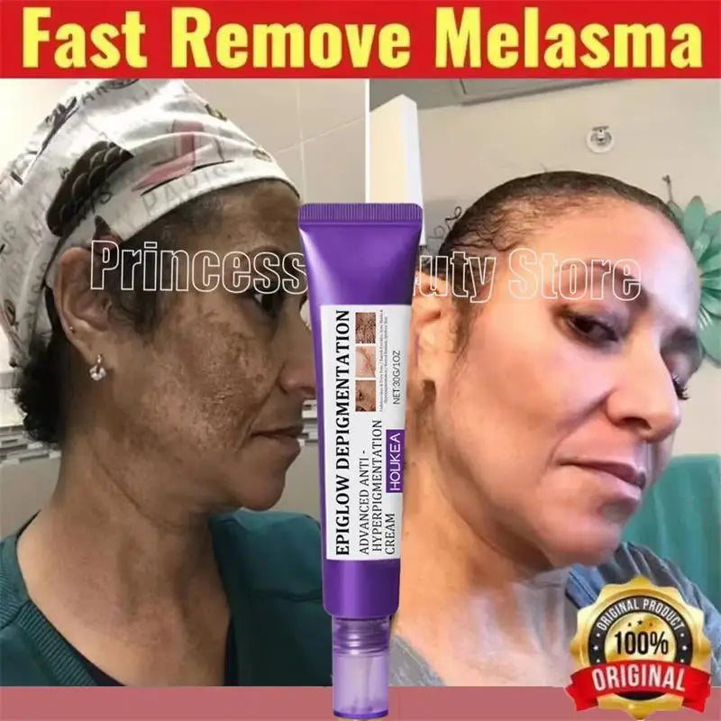 Whitening Freckle Cream Melasma Dark Spots Pigmentation Removal Product Fade Stain Melanin Fast Repair Brighten Korean Skin Care 1PC