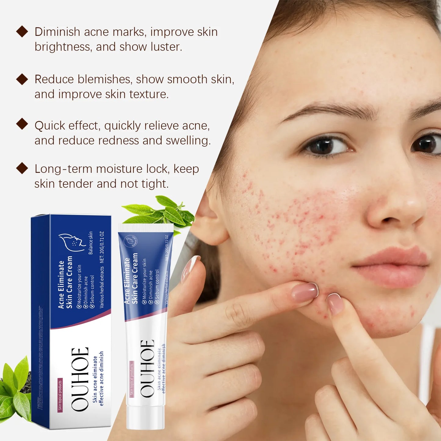 Pimple Acne Treatment Face Cream Nourish Balance Oil Control Refreshing Repairing Pimple Remover Acne Removing Cleansing Cream