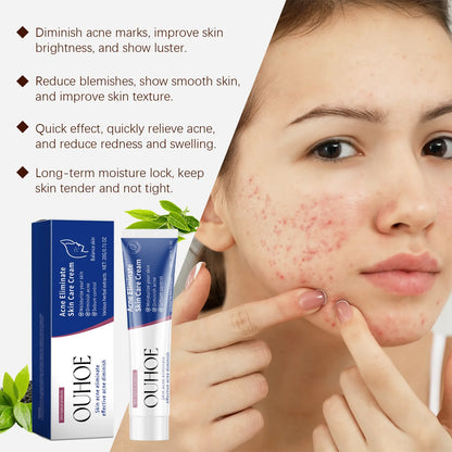 Pimple Acne Treatment Face Cream Nourish Balance Oil Control Refreshing Repairing Pimple Remover Acne Removing Cleansing Cream