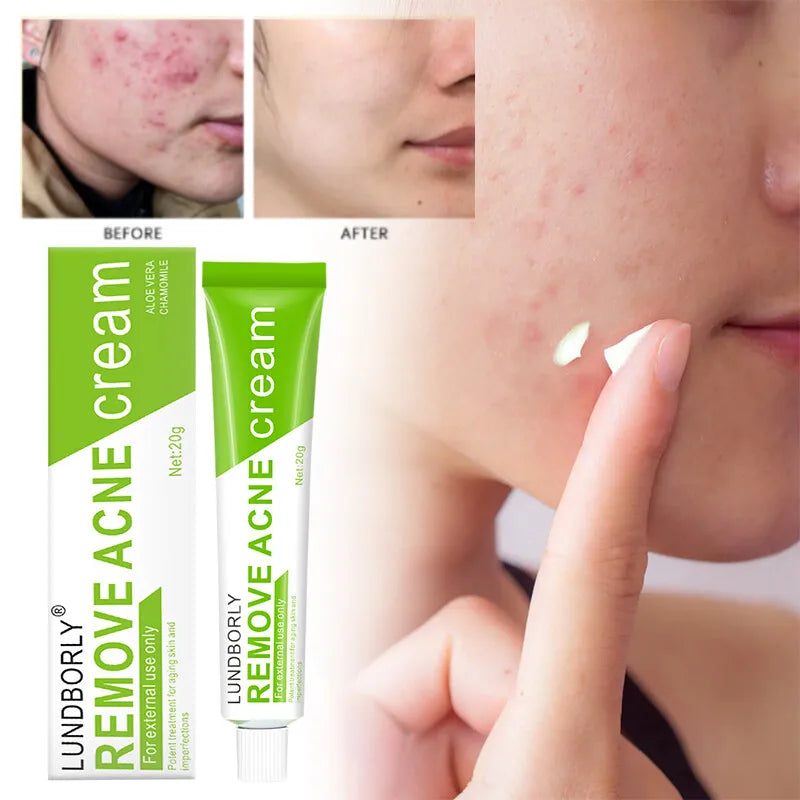 Natural Herbal Face Cream 20g Acne Cream with Salicylic Acid Oil Control Moisturizing Fading Acne Marks Gentle Non Irritating