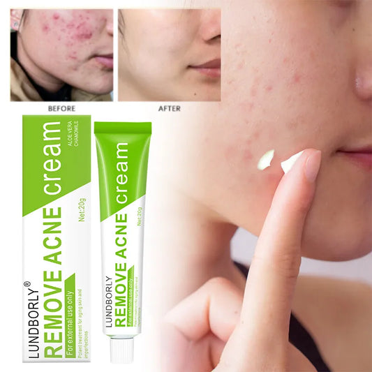 Natural Herbal Face Cream 20g Acne Cream with Salicylic Acid Oil Control Moisturizing Fading Acne Marks Gentle Non Irritating