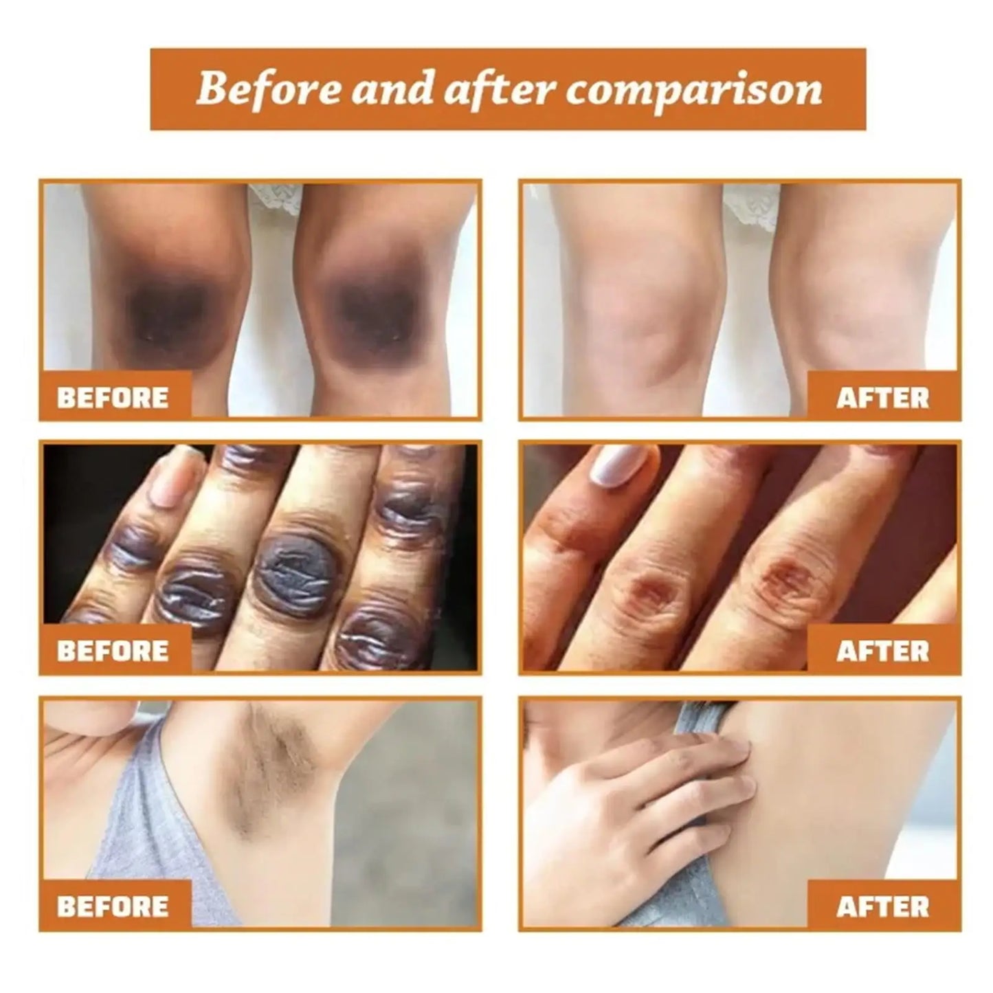 Strong Yellow Peeling Oil Bleach Dark Skin Whiten Lotion Lighten Body Elbow Knee Hand Exfoliate Dead Skin Nourish Even Skin Tone