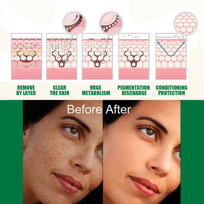 Nicotinamide Whitening Freckles Face Cream Remove Melasma Dark Spots Corrector Fade Melanin Acne Anti-Aging Brighten Skin Care