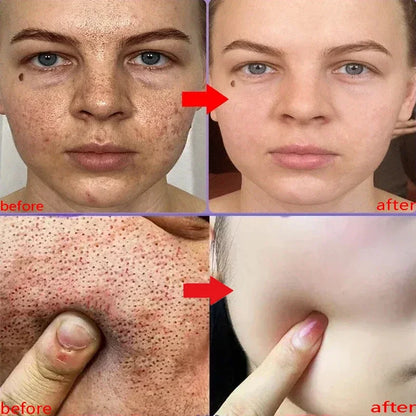 Salicylic Acid Pore Shrinking Cream Eliminate Large Pores Serum Remove Blackhead Acne Repairing Tightening Skin Care Cosmetics