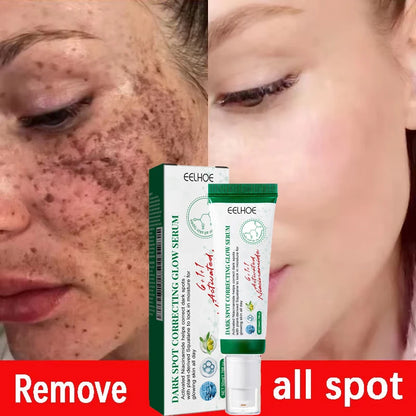 Nicotinamide Whitening Freckles Face Cream Remove Melasma Dark Spots Corrector Fade Melanin Acne Anti-Aging Brighten Skin Care