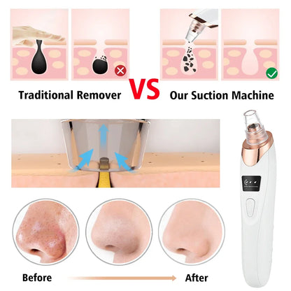 Okayso Blackhead Remover with Acne Needle Vacuum Pore Cleaner Black Pimple Blemish Remove for Face&Nose Skin Care Tool Kit