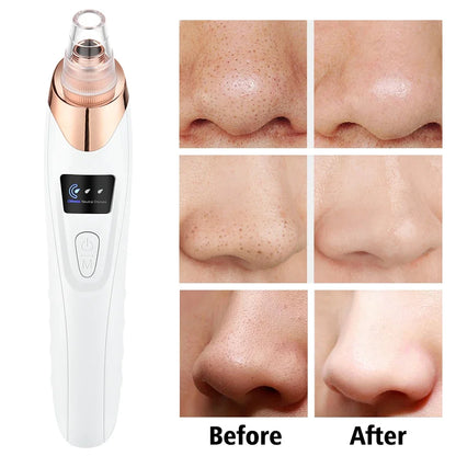 Okayso Blackhead Remover with Acne Needle Vacuum Pore Cleaner Black Pimple Blemish Remove for Face&Nose Skin Care Tool Kit