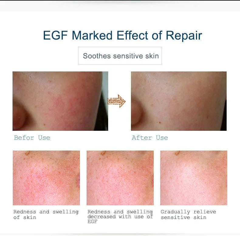 ARTISCARE EGF Face Serum for Skin Care Moisturizing Rejuvenation Cream Facial Oil Control Shrink Pores Essence