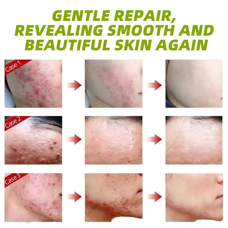 30g Acne Cream soothes, hydrates, helps regulate oil, reduces redness, and enhances skin texture with a moisturizing feel