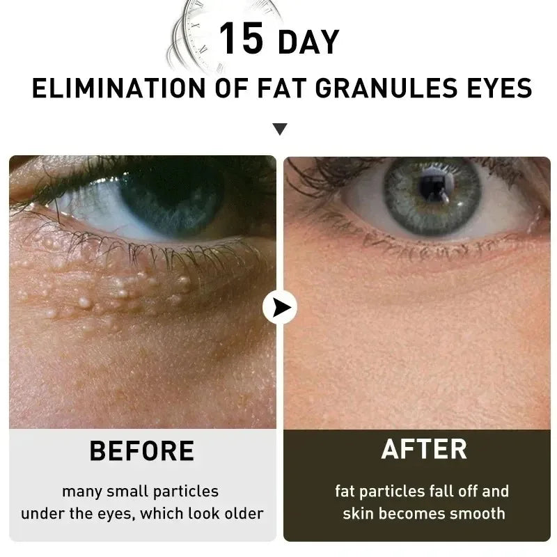 Fat Granules Remover Eye Cream Effective Remove Fat Granules Puffiness Anti-Particles Milia Remover Product Repair Eye Skin Care