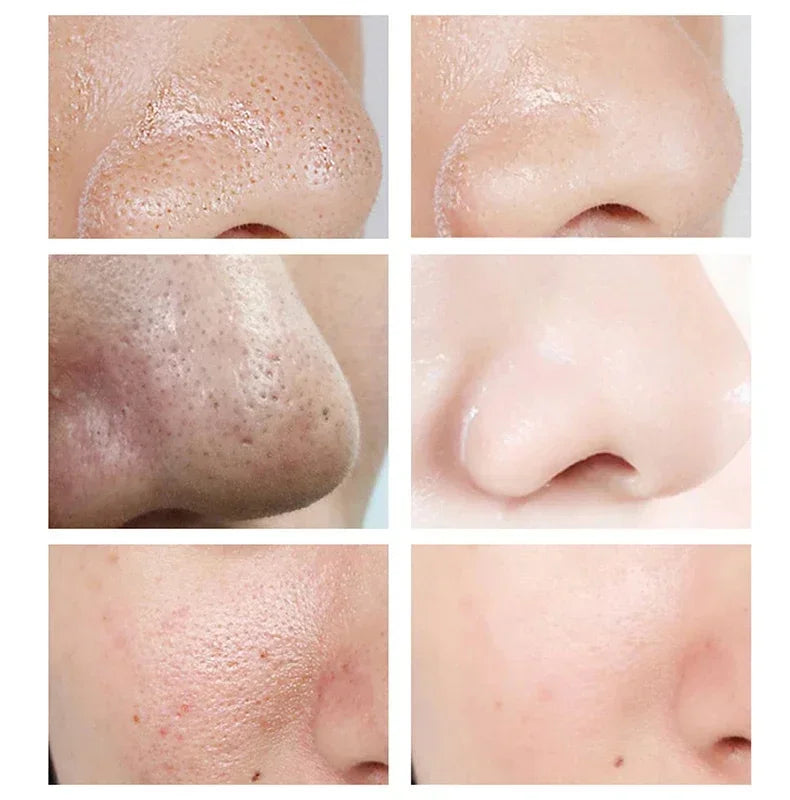 Salicylic Acid Pore Shrinking Cream Eliminate Large Pores Serum Remove Blackhead Acne Repairing Tightening Skin Care Cosmetics