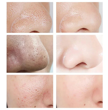 Salicylic Acid Pore Shrinking Cream Eliminate Large Pores Serum Remove Blackhead Acne Repairing Tightening Skin Care Cosmetics