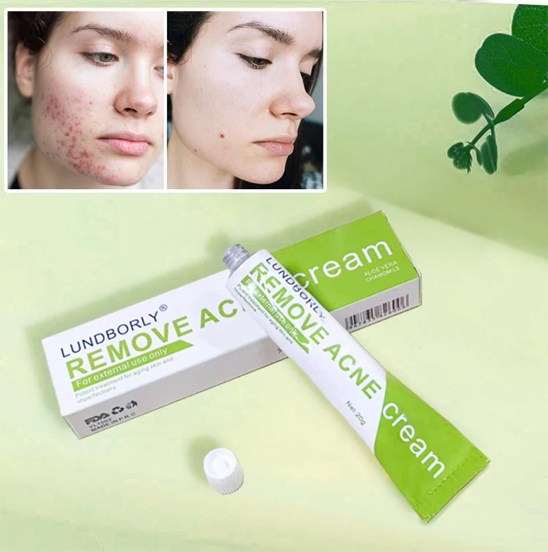 LUNDBORLY Acne Care Cream with Natural Herbal Extracts Helps Soothe Skin Improve Skin Texture and Keep Skin Smooth and Radiant