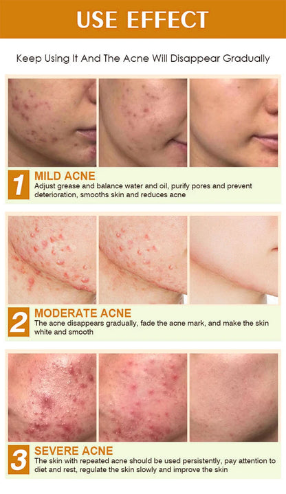 LUNDBORLY Acne Care Cream with Natural Herbal Extracts Helps Soothe Skin Improve Skin Texture and Keep Skin Smooth and Radiant