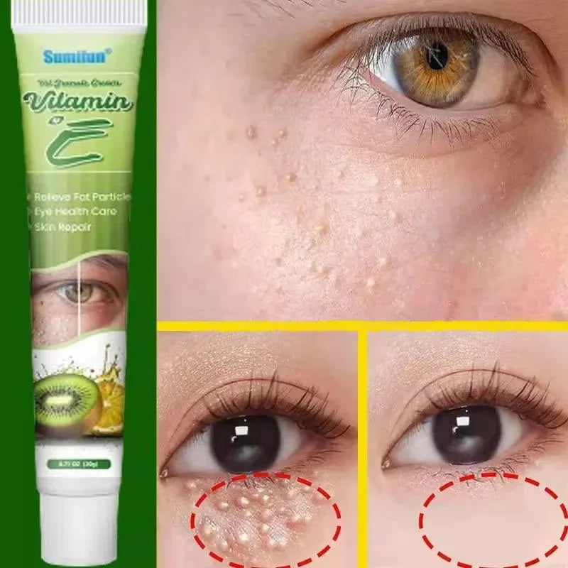 Fat Granules Remover Eye Cream Skin Care Products