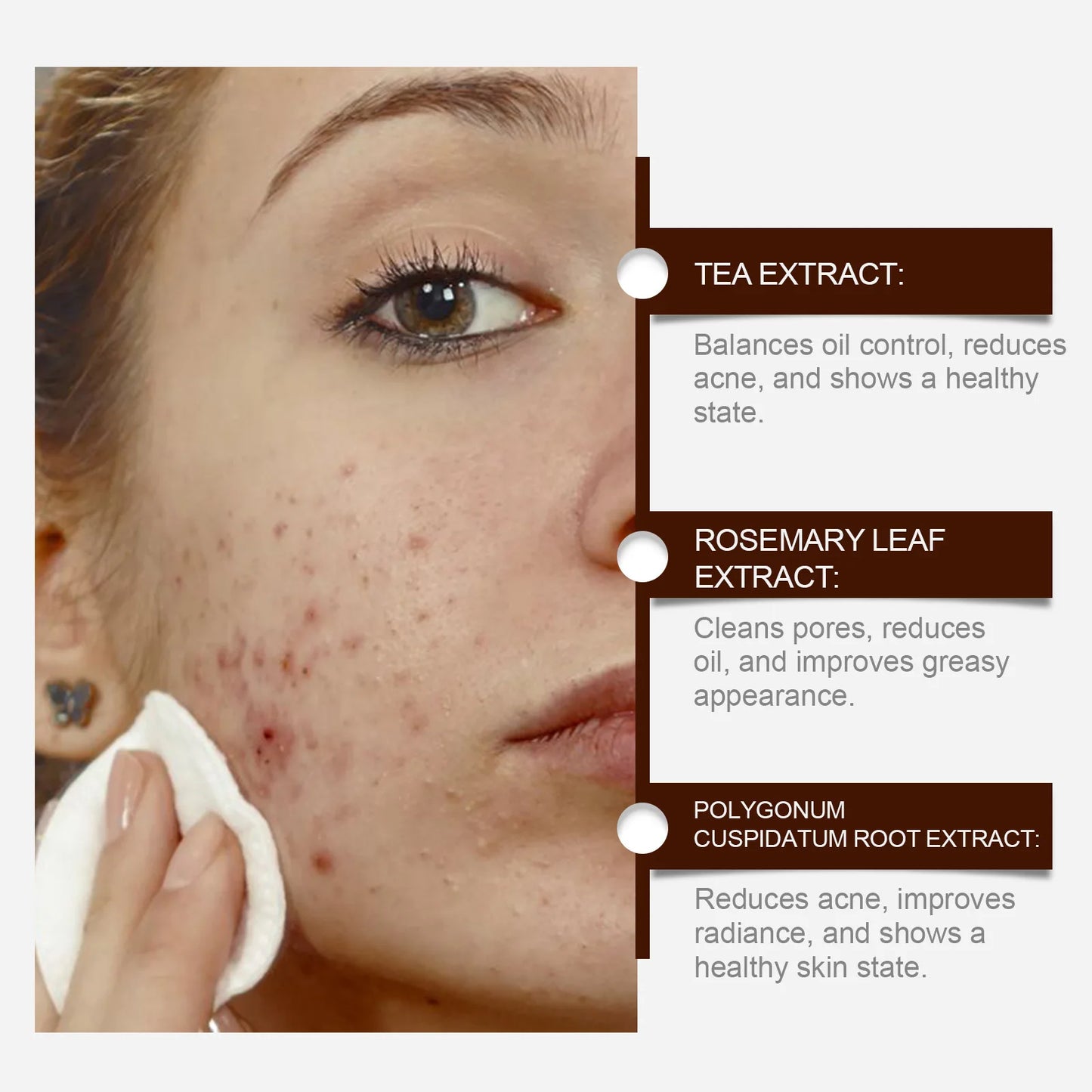 Pimple Acne Treatment Face Cream Nourish Balance Oil Control Refreshing Repairing Pimple Remover Acne Removing Cleansing Cream