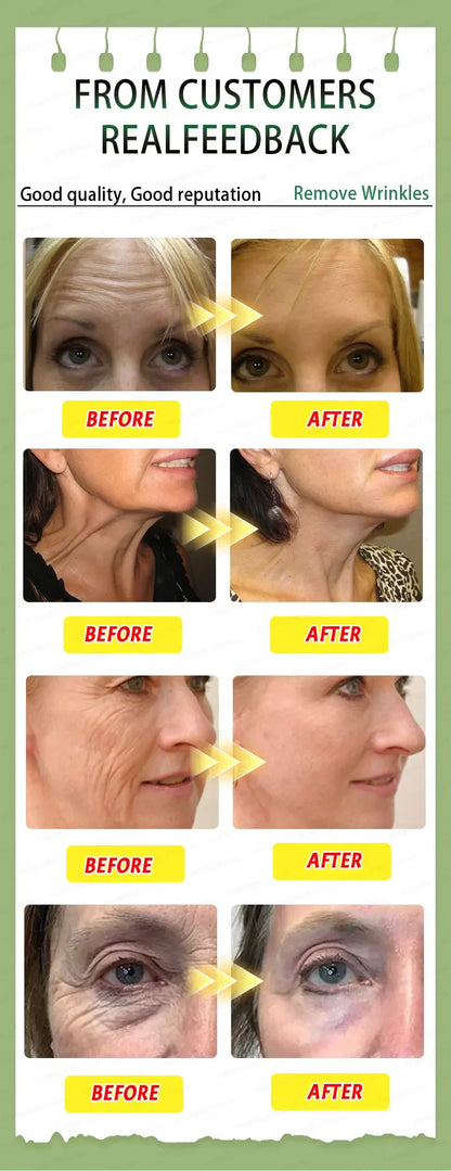 Wrinkles disappear,20 years younger