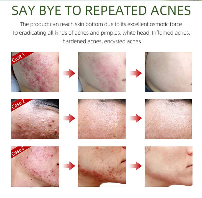 Natural Herbal Face Cream 20g Acne Cream with Salicylic Acid Oil Control Moisturizing Fading Acne Marks Gentle Non Irritating