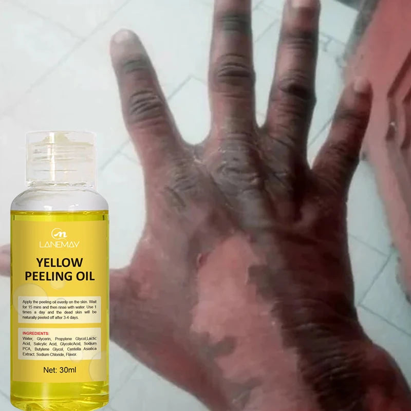 Strong Yellow Peeling Oil Bleach Dark Skin Whiten Lotion Lighten Body Elbow Knee Hand Exfoliate Dead Skin Nourish Even Skin Tone