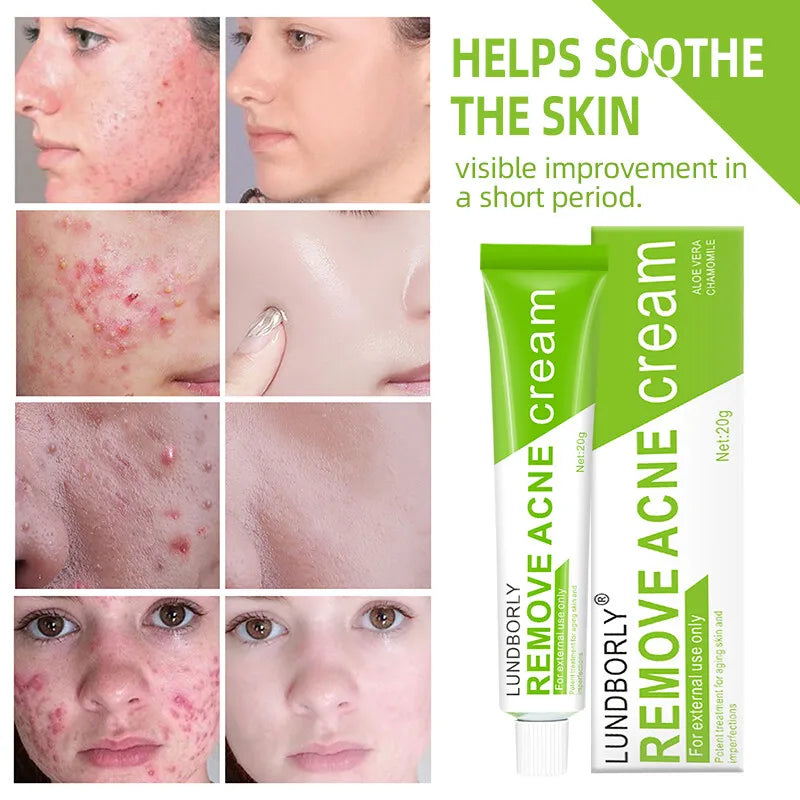 Natural Herbal Face Cream 20g Acne Cream with Salicylic Acid Oil Control Moisturizing Fading Acne Marks Gentle Non Irritating