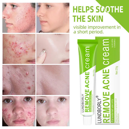 Natural Herbal Face Cream 20g Acne Cream with Salicylic Acid Oil Control Moisturizing Fading Acne Marks Gentle Non Irritating