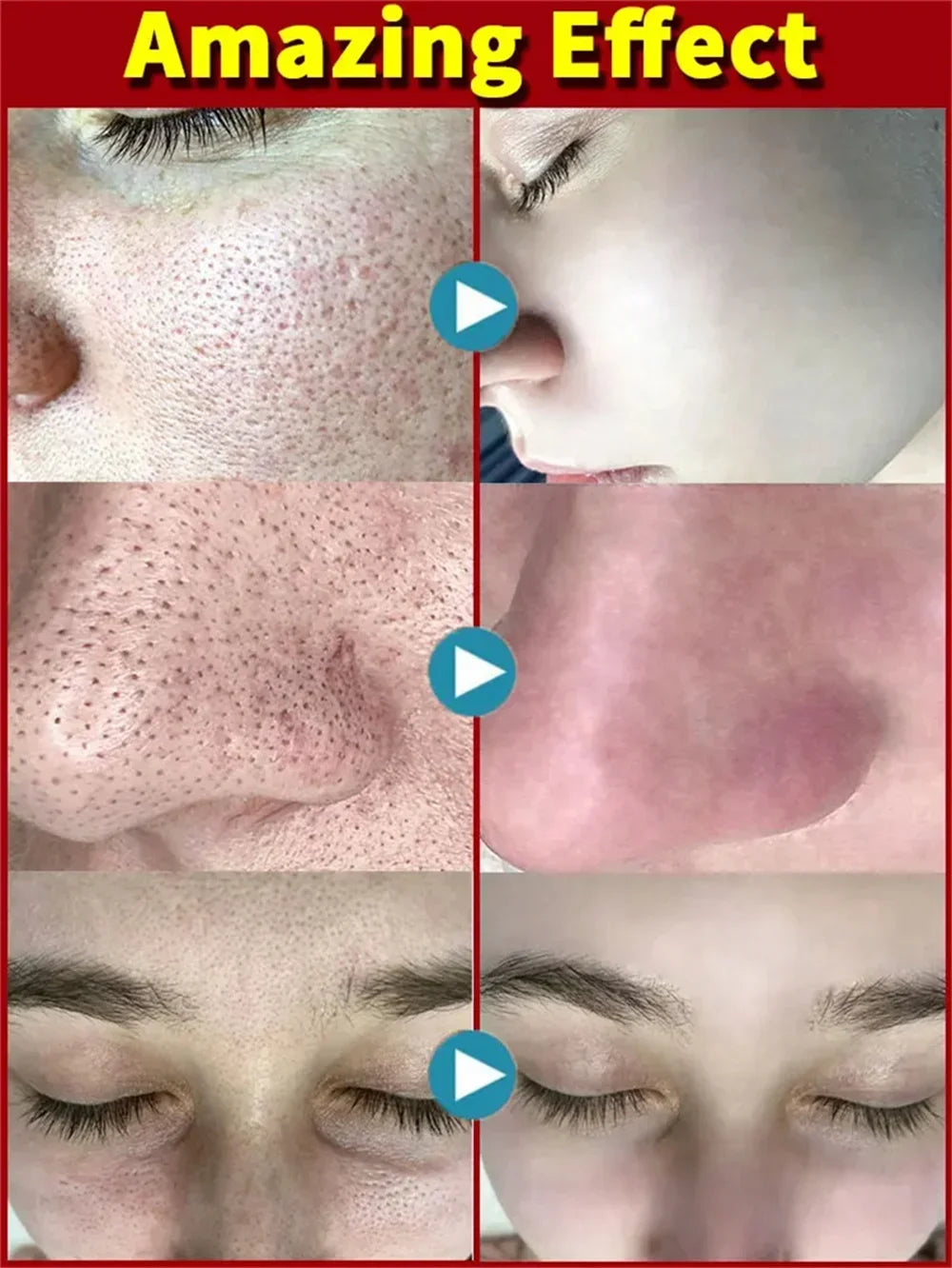 Salicylic Acid Pore Shrinking Cream Eliminate Large Pores Serum Remove Blackhead Acne Repairing Tightening Skin Care Cosmetics