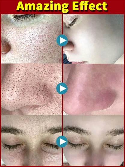 Salicylic Acid Pore Shrinking Cream Eliminate Large Pores Serum Remove Blackhead Acne Repairing Tightening Skin Care Cosmetics